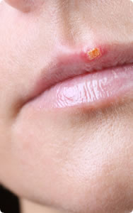 Mild Cold Sore