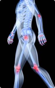 Rheumatism