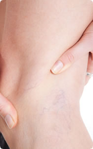 Varicose veins