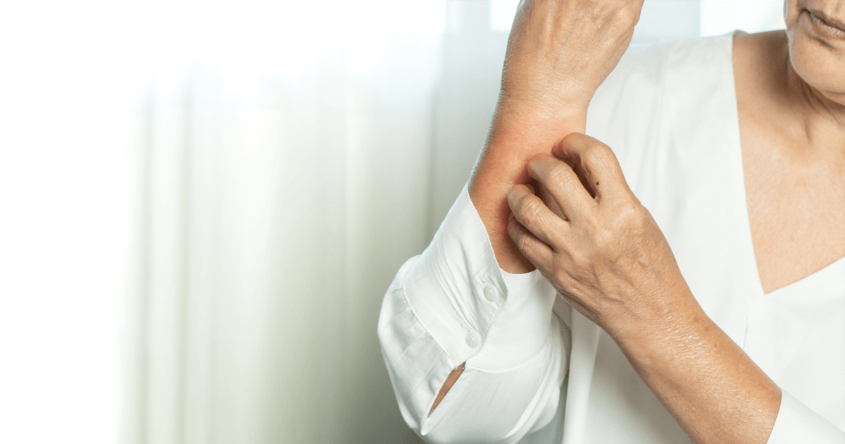 Is it normal to have itchy skin all over in perimenopause and menopause