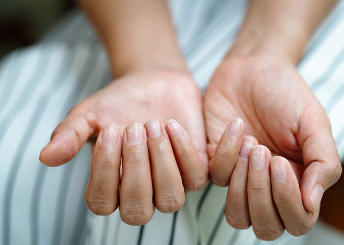 Are brittle nails a symptom of perimenopause and menopause? 
