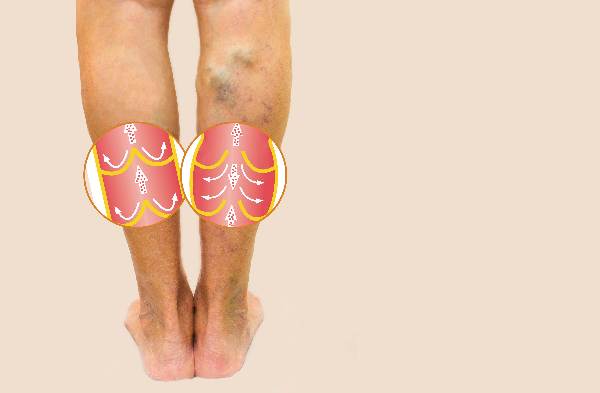 4 ways to prevent varicose veins naturally