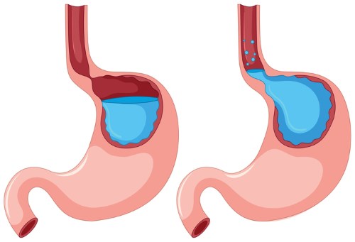 Why is exercising causing me acid reflux?