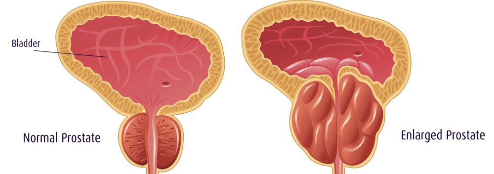 does heavy drinking cause prostate problems