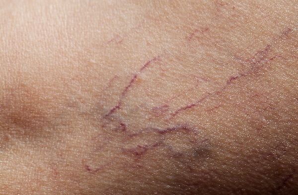 What are spider veins?