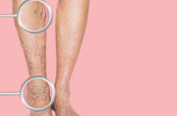 What Do Varicose Veins Look Like 