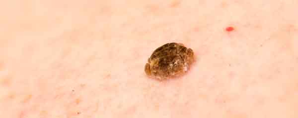 Can You Get Rid Of Age Spots Can You Get Rid Of Age Spots