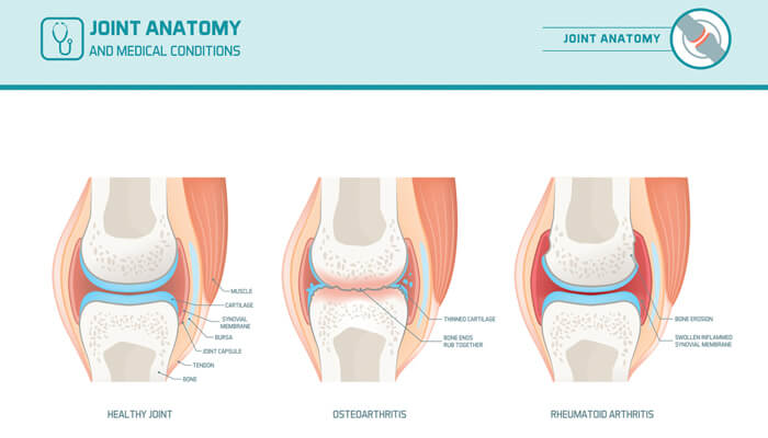 Common causes of muscle and joint pain