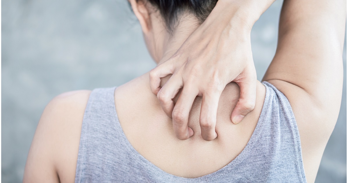 Why does sweat make my eczema worse?