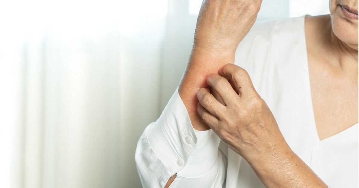 Can you develop eczema later in life?