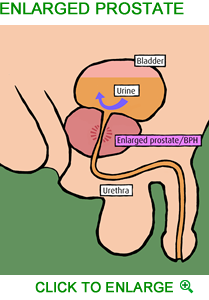 A prostatitis badami kezelése